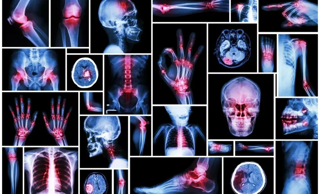 Možná máte vyšší citlivost na bolest: Vědci ji spojují s DNA neandrtálců