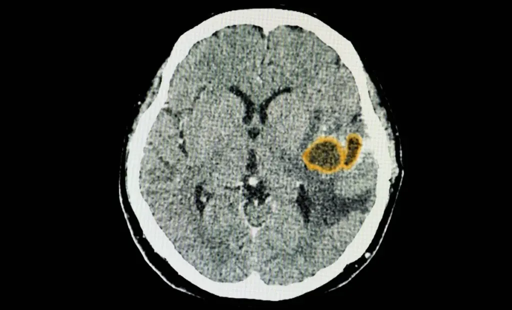 Parazit v mozku si ochočil imunitní buňky. Důvod, proč to neřešíte, je v jednom enzymu