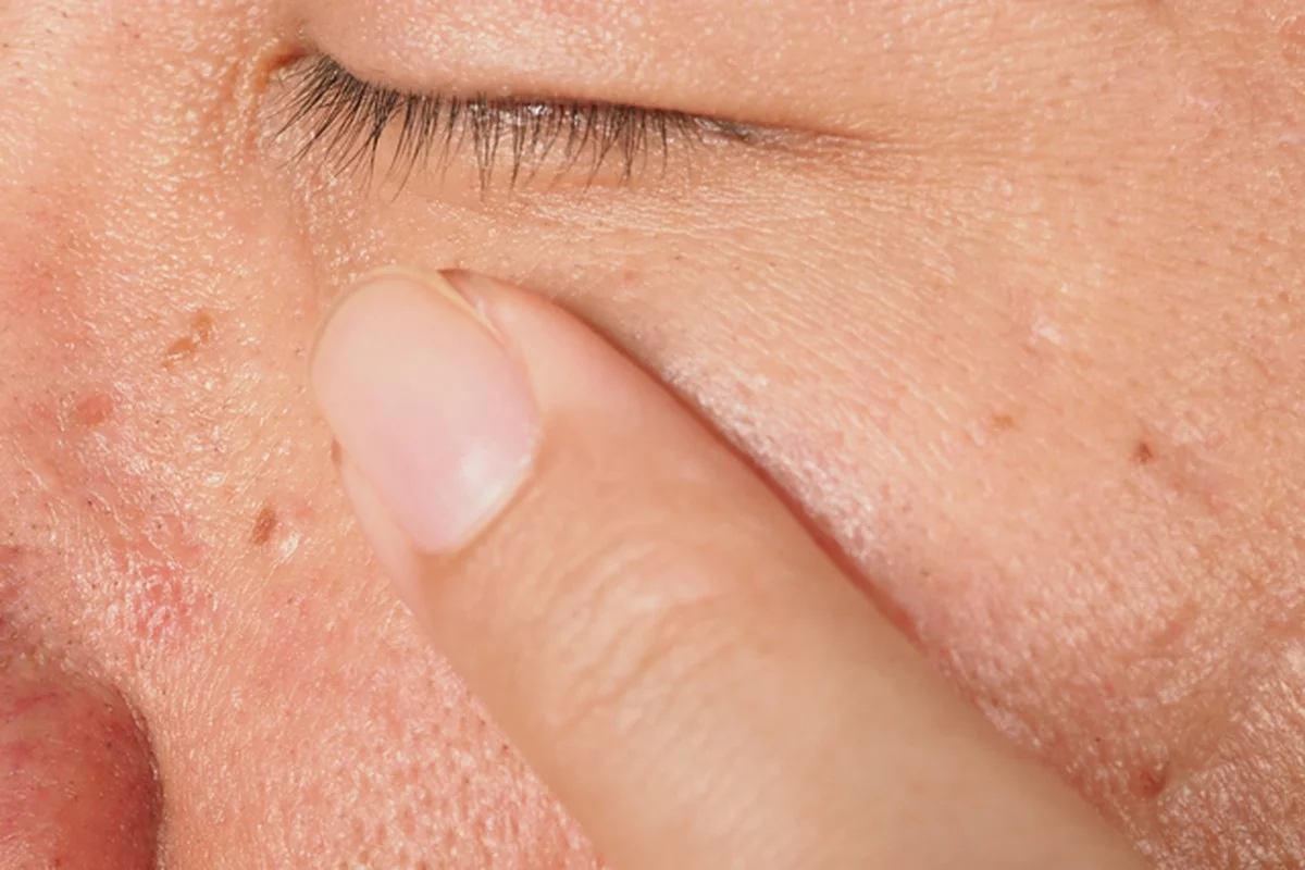 Proč se bradavice pořád vrací? Zkušení kožaři radí: Nezapomeňte dezinfikovat tuto jednu věc - image 2