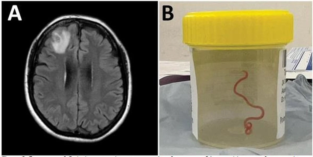 Parazit z krajty objevili u ženy: Co to znamená pro nás? - image 1