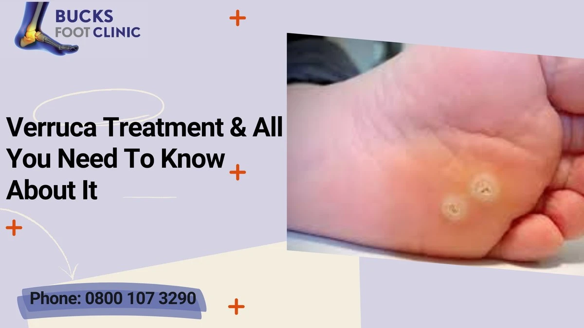 Proč jste se zbavili bradavic a ony se vrátily? Skrytý trik, na který zapomínáme u rodičů! - image 1