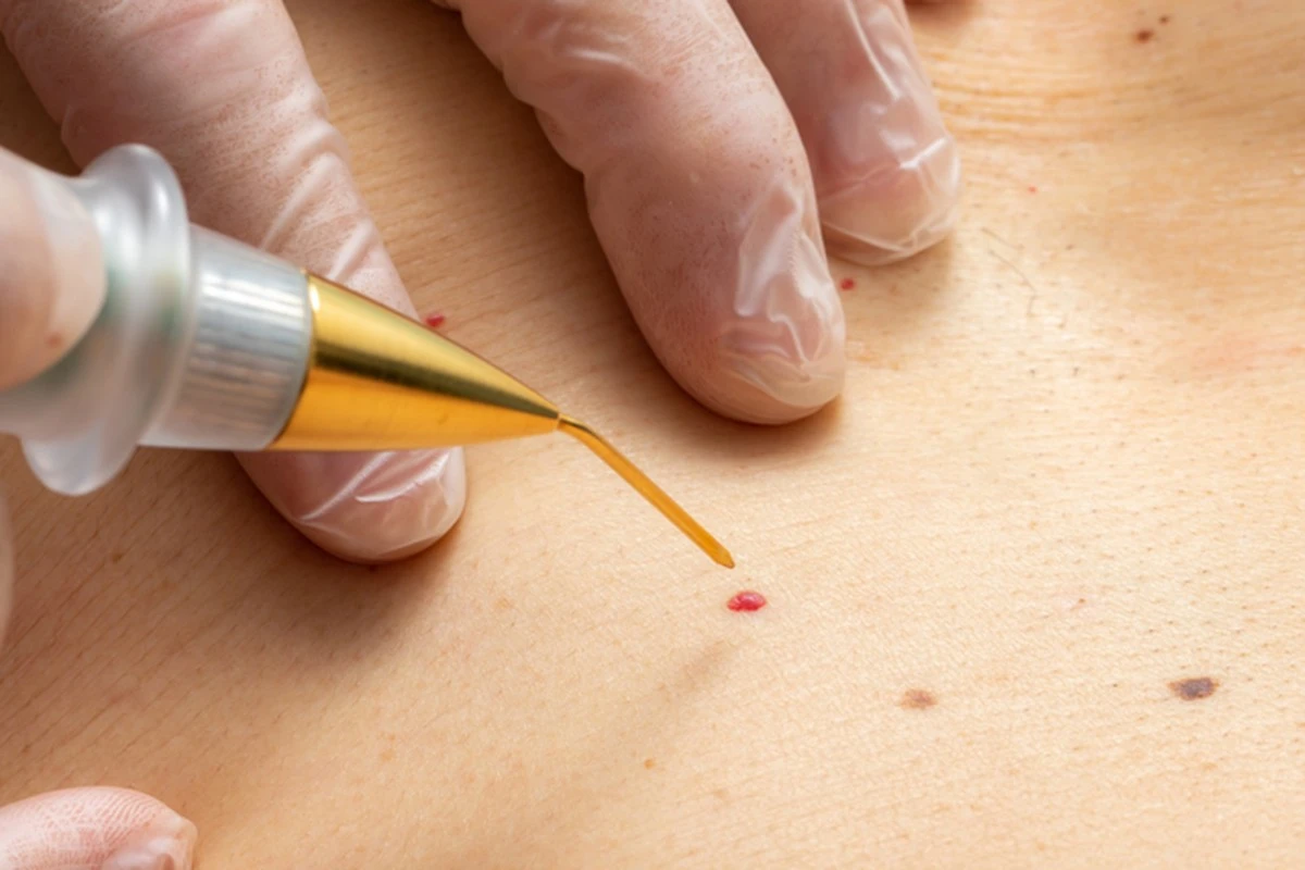 Proč jste se zbavili bradavic a ony se vrátily? Skrytý trik, na který zapomínáme u rodičů! - image 2